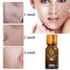 Dredge Meridian Skin Care Natural Pure Removal Acne Stretch Marks Scar Removal Essence oil - Image 3